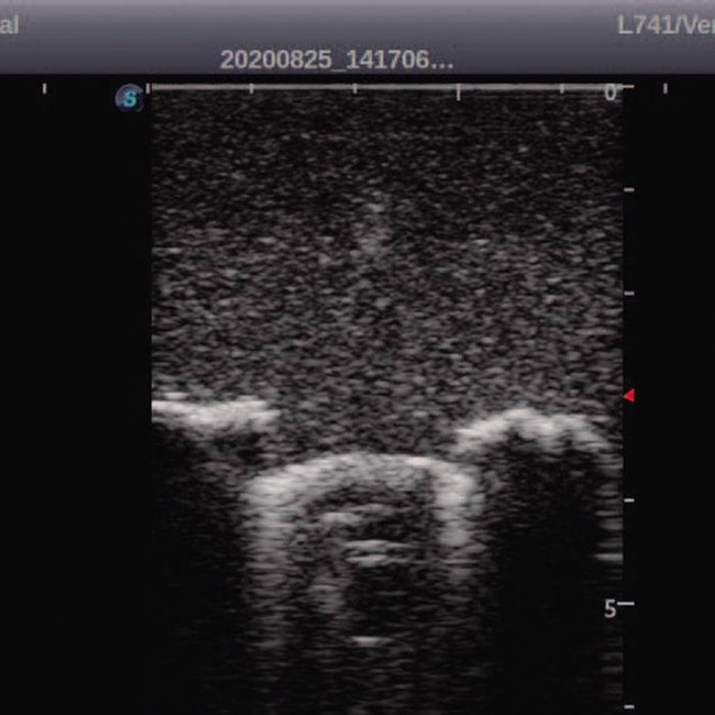 Simulador Pediátrico para Treinamento de Punção Lombar Guiada por Ultrassom-942f20e1-cb1d-4eb8-8acb-d2b039ad725a