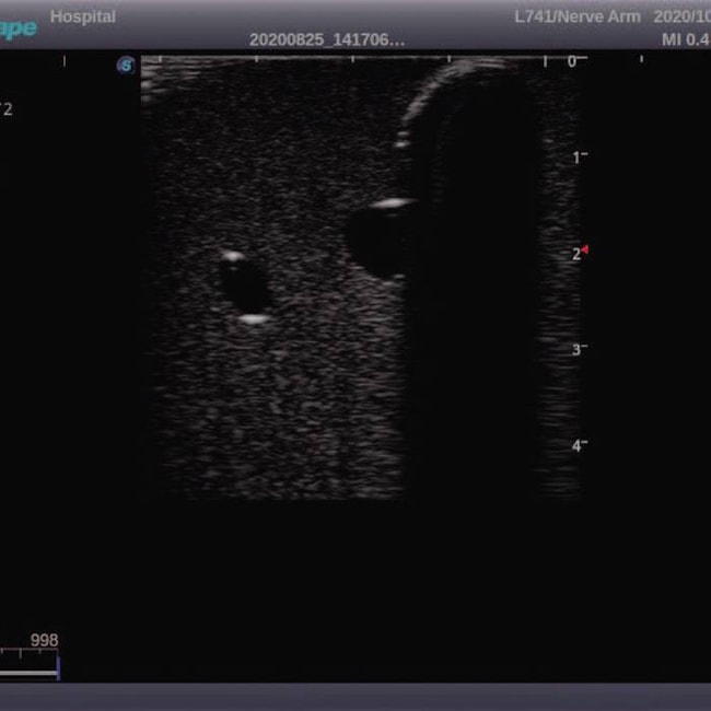 Simulador Torso para Treinamento de Cateterismo Venoso Central Guiado por Ultrassom-69337de6-b768-42d9-ab90-4e92dbf7f4d7