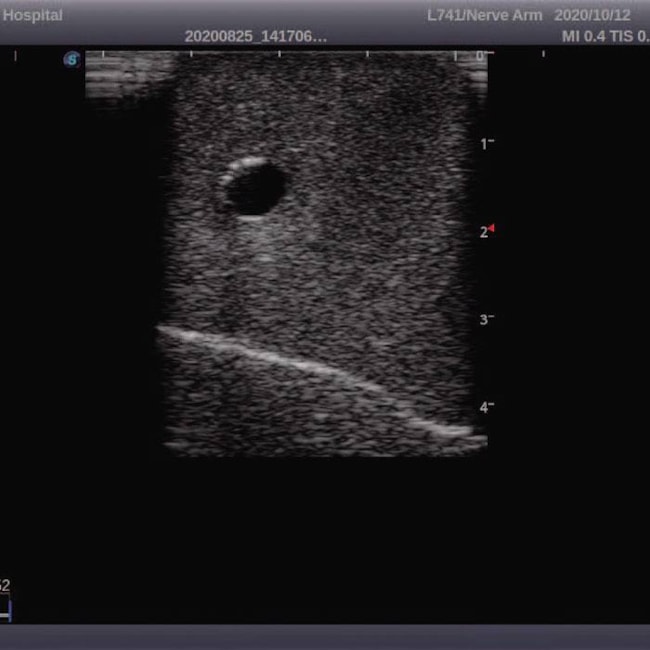 Simulador Torso para Treinamento de Cateterismo Venoso Central Guiado por Ultrassom-f6dd1bcf-4084-41e0-8caf-de379eb9b9e9