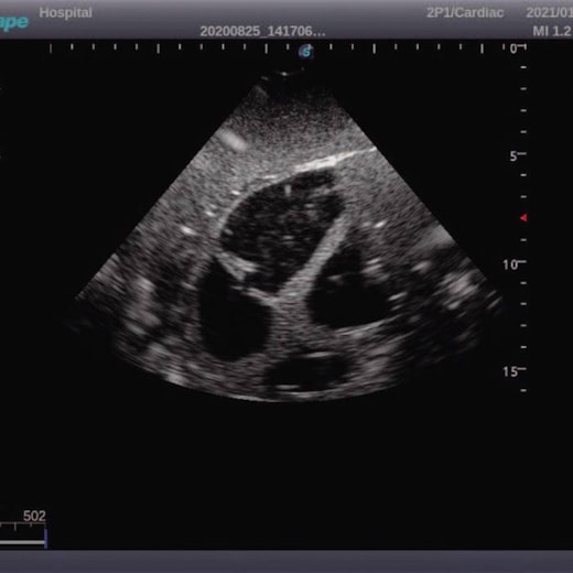 Simulador Torso Phantom para Treinamento de Ultrassonografia