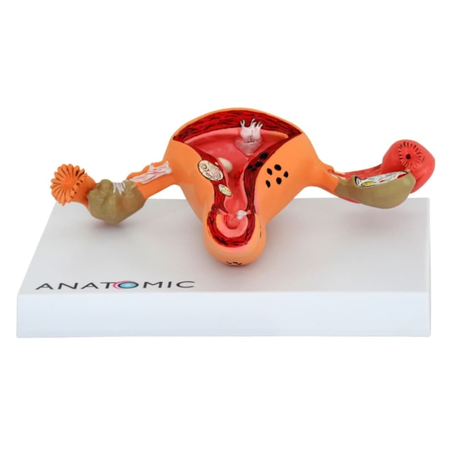 Útero com Trompas Patológico-95e44bb1-dfe6-405d-b83a-f22e383841e6