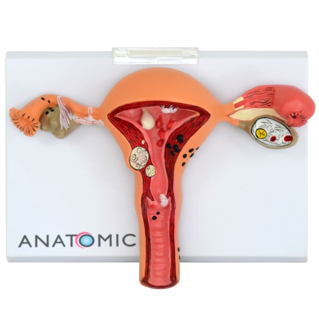 Útero com Trompas Patológico-2f32356b-f6ab-435a-84e5-d7258188aac6