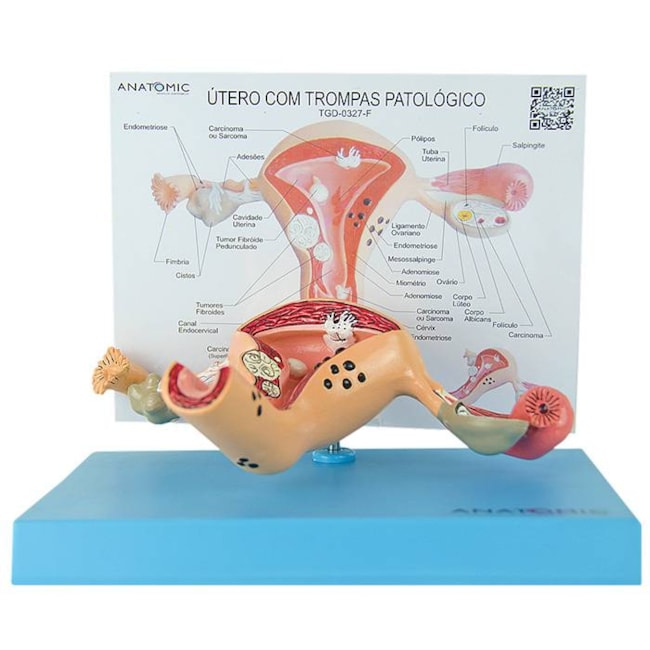 Útero com Trompas Patológico-e945f383-4614-4d47-a4c8-ecf57d0f4ded