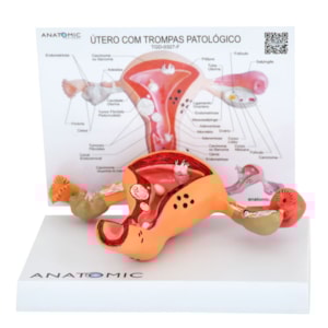 Útero com Trompas Patológico