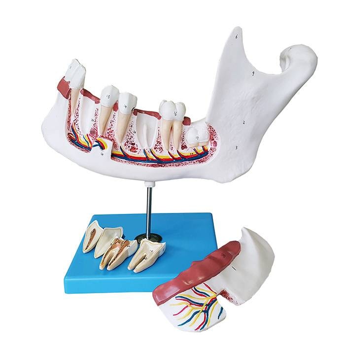 Modelo de mandíbula inferior de jovem em 6 partes com dentes removíveis e cárie
