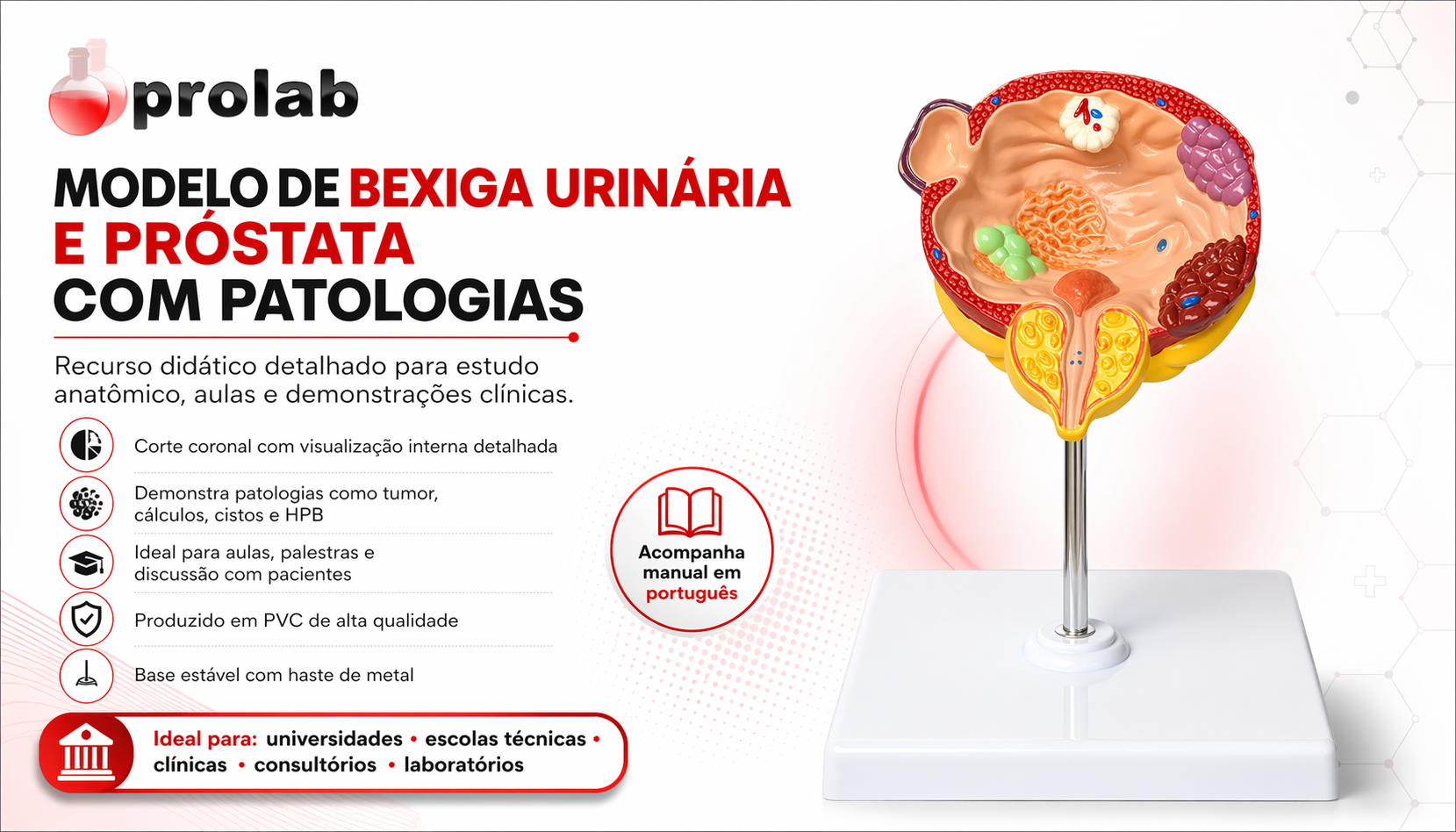 Modelo Anatomico de Bexiga Urinaria e Prostata com Patologias TZJ-0363-P — vista em corte coronal